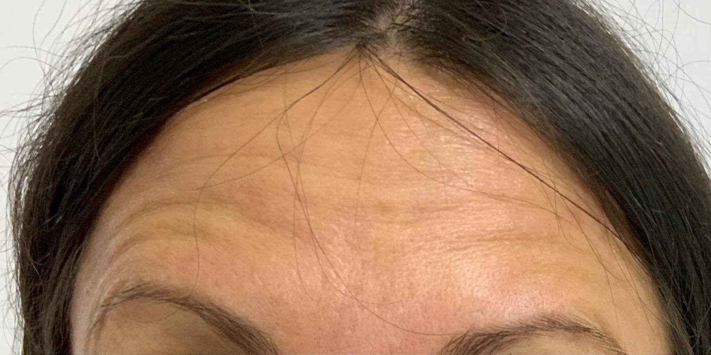 Injection de botox - avant